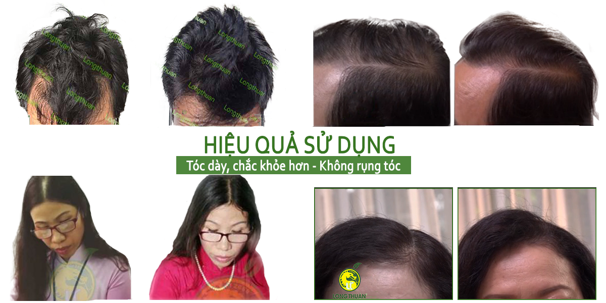 Tóc mọc dày kể cả hòi nhờ chai tinh dầu hoa bưởi đặc biệt Long Thuận